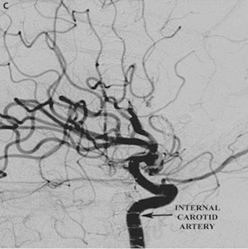 Post-operative lateral angiogram demonstrating resection of the AVM