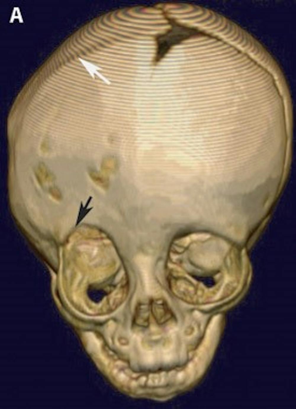 Pre-operative 3-D CT reconstruction of the skull demonstrating the effects of craniosynostosis. Note how the premature fusion of the right coronal suture (white arrow) has led to a distortion of the overall shape of the skull and right orbit