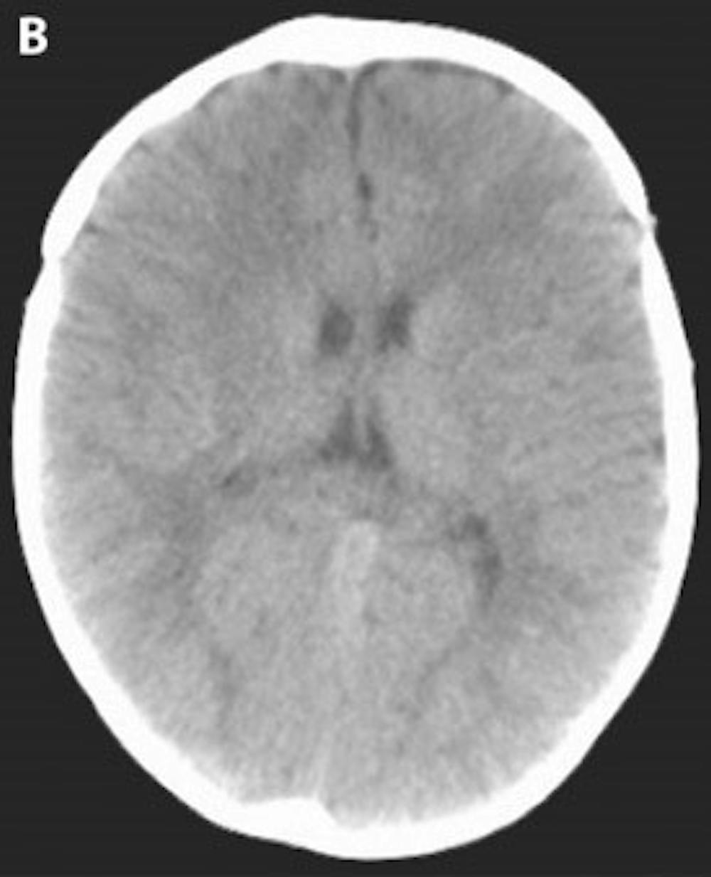 Post-operative head CT demonstrating a more cosmetically normal, rounded appearance to the skull