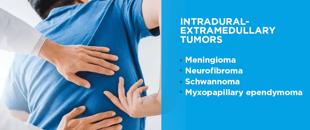 Tumeurs intradurales-extramédullaires