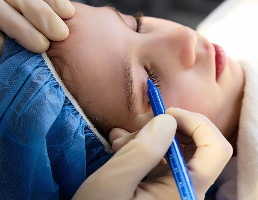 girl getting her eyelids dotted with pen for procedure