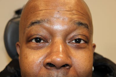 Ptosis Repair Before & After Gallery - Patient 160356 - Image 2
