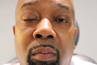 Ptosis Repair Before & After Gallery - Patient 160356 - Image 1