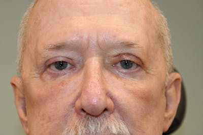 Ptosis Repair Before & After Gallery - Patient 315828 - Image 2