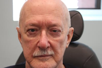 Ptosis Repair Before & After Gallery - Patient 315828 - Image 1