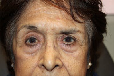 Ptosis Repair Before & After Gallery - Patient 250520 - Image 2