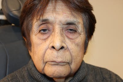 Ptosis Repair Before & After Gallery - Patient 250520 - Image 1