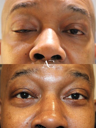Ptosis Repair Before & After Gallery - Patient 160356 - Image 1