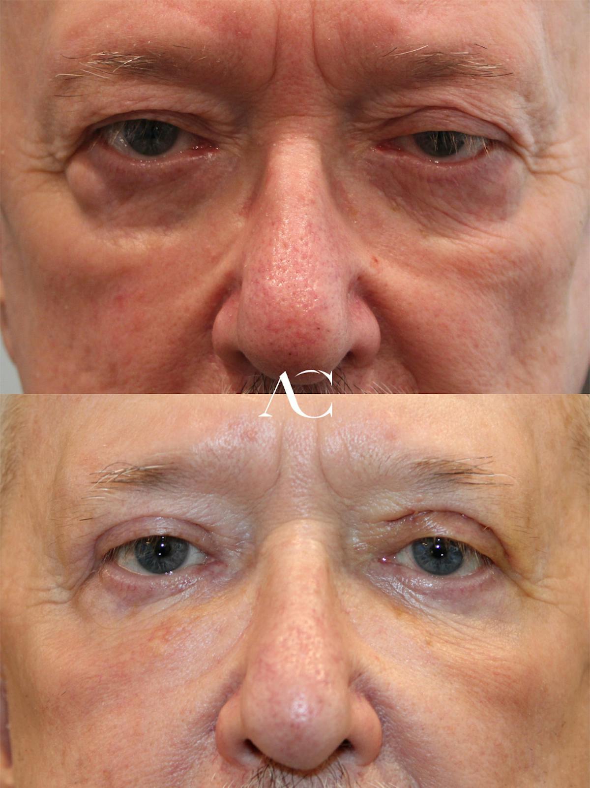 Ptosis Repair Before & After Gallery - Patient 315828 - Image 1