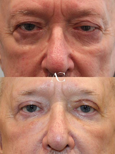 Ptosis Repair Before & After Gallery - Patient 315828 - Image 1