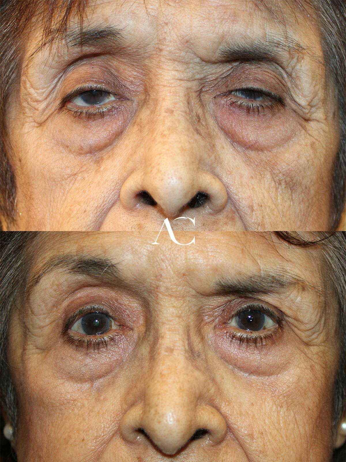 Ptosis Repair Before & After Gallery - Patient 250520 - Image 1