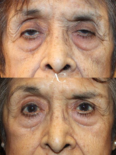 Ptosis Repair Before & After Gallery - Patient 250520 - Image 1