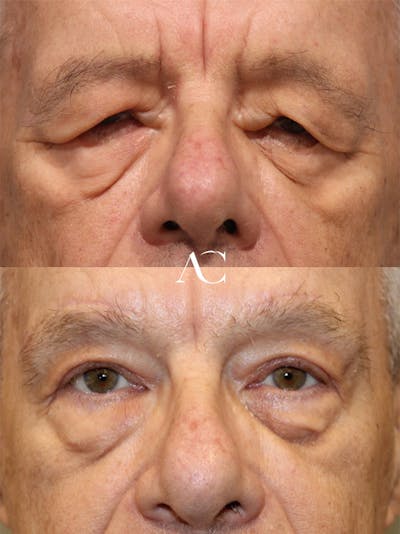 Upper Blepharoplasty Before & After Gallery - Patient 152029 - Image 1