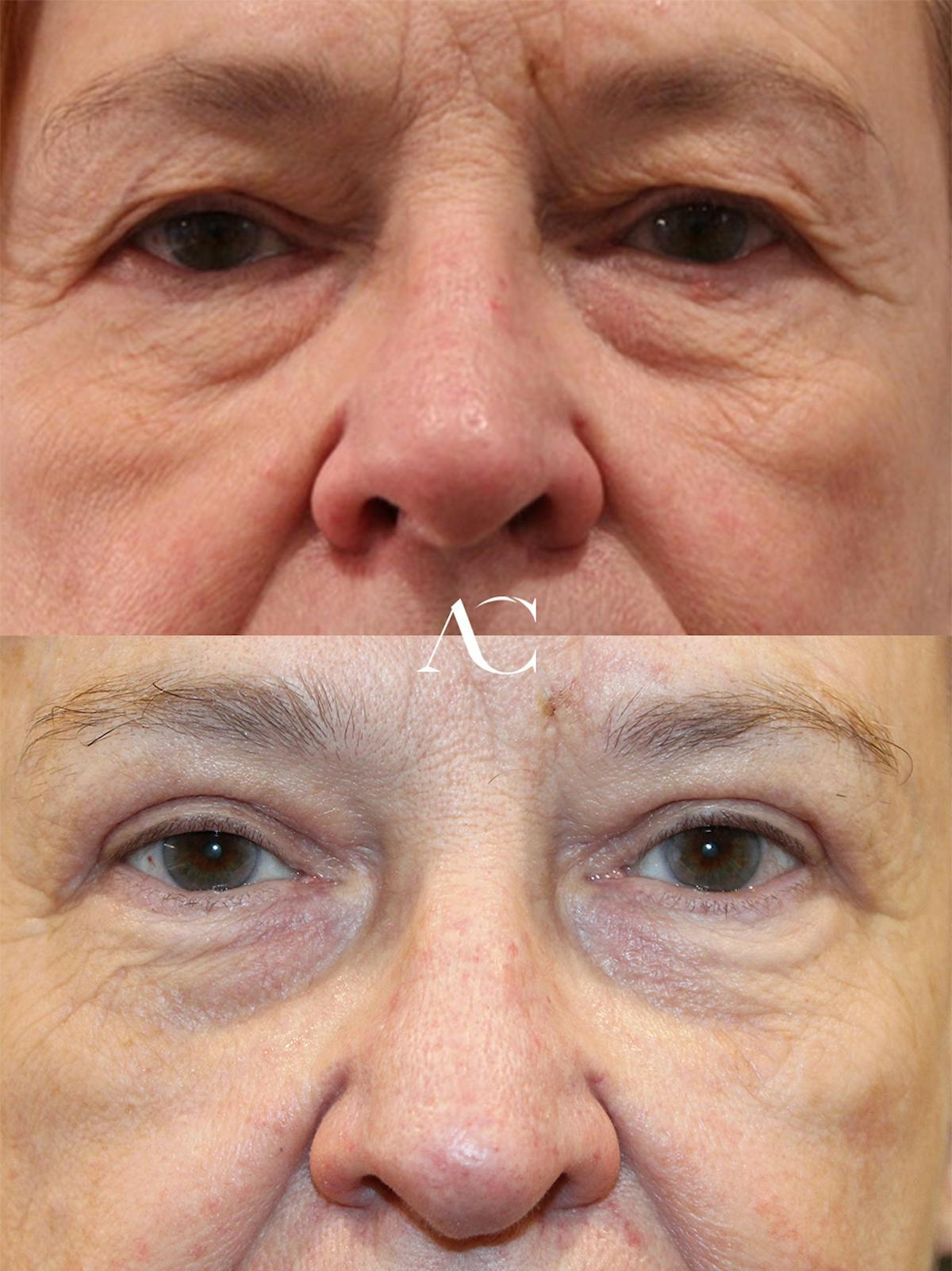 Upper Blepharoplasty Before & After Gallery - Patient 922068 - Image 1