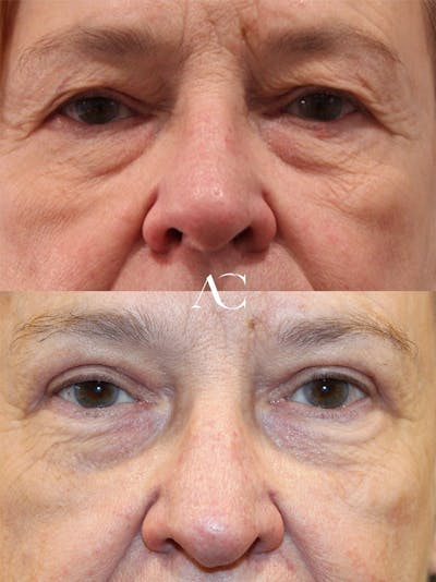 Upper Blepharoplasty Before & After Gallery - Patient 922068 - Image 1