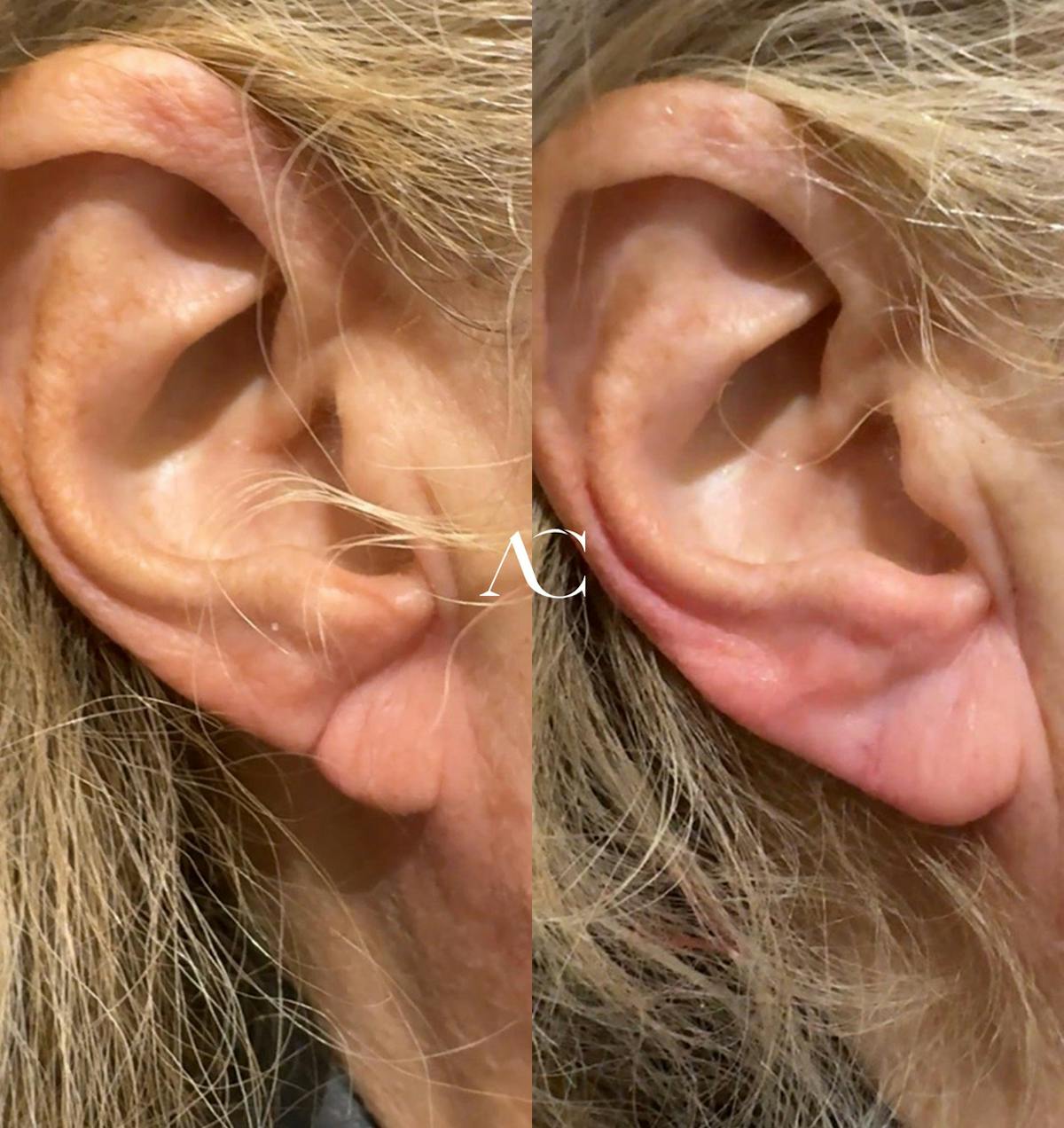 Earlobe Repair Before & After Gallery - Patient 407720 - Image 1