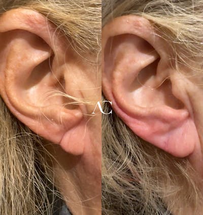 Earlobe Repair Before & After Gallery - Patient 407720 - Image 1
