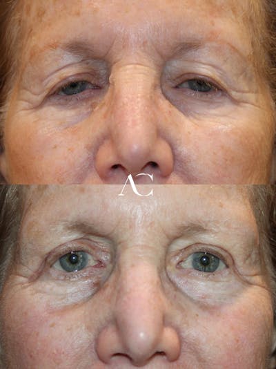 Upper Blepharoplasty Before & After Gallery - Patient 278532 - Image 1
