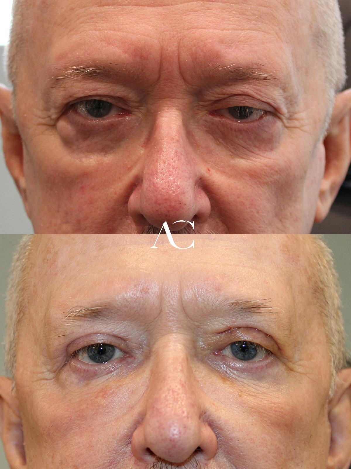 Upper Blepharoplasty Before & After Gallery - Patient 229997 - Image 1