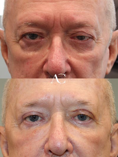 Upper Blepharoplasty Before & After Gallery - Patient 229997 - Image 1