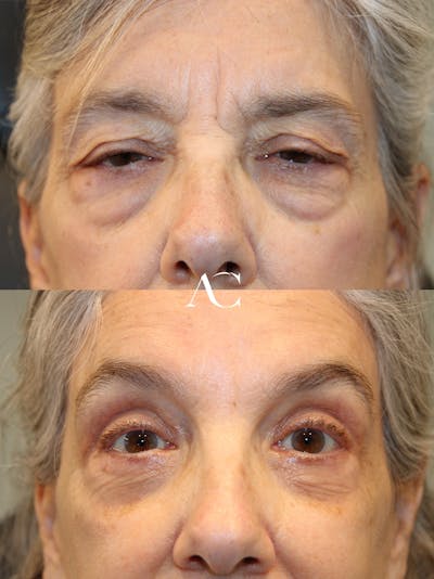 Upper Blepharoplasty Before & After Gallery - Patient 110145 - Image 1