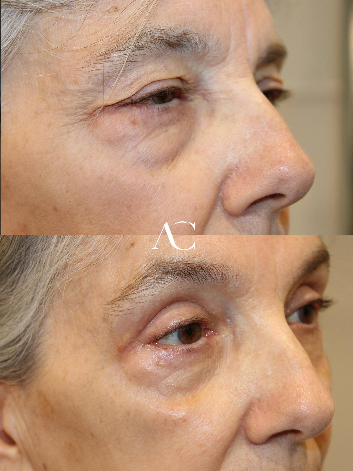 Upper Blepharoplasty Before & After Gallery - Patient 110145 - Image 2