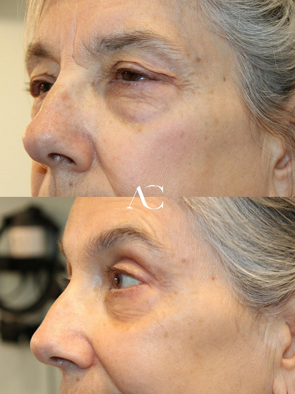 Upper Blepharoplasty Before & After Gallery - Patient 110145 - Image 3