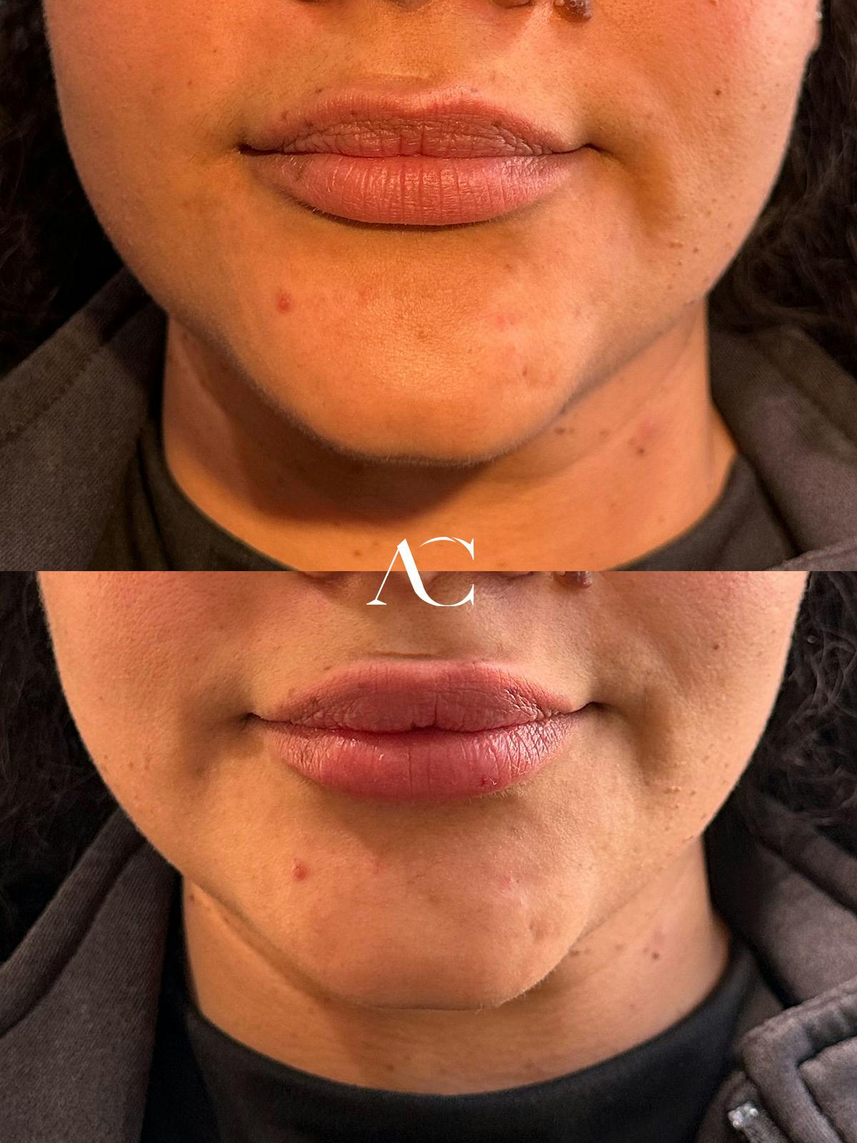 Lip Filler Before & After Gallery - Patient 348040 - Image 1