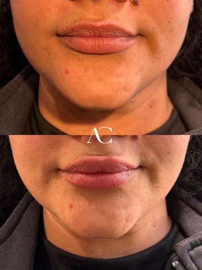 Lip Filler Before & After Gallery - Patient 348040 - Image 1