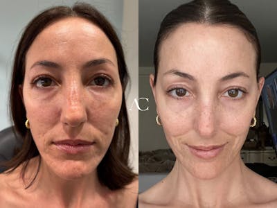 Lip Filler Before & After Gallery - Patient 384263 - Image 1