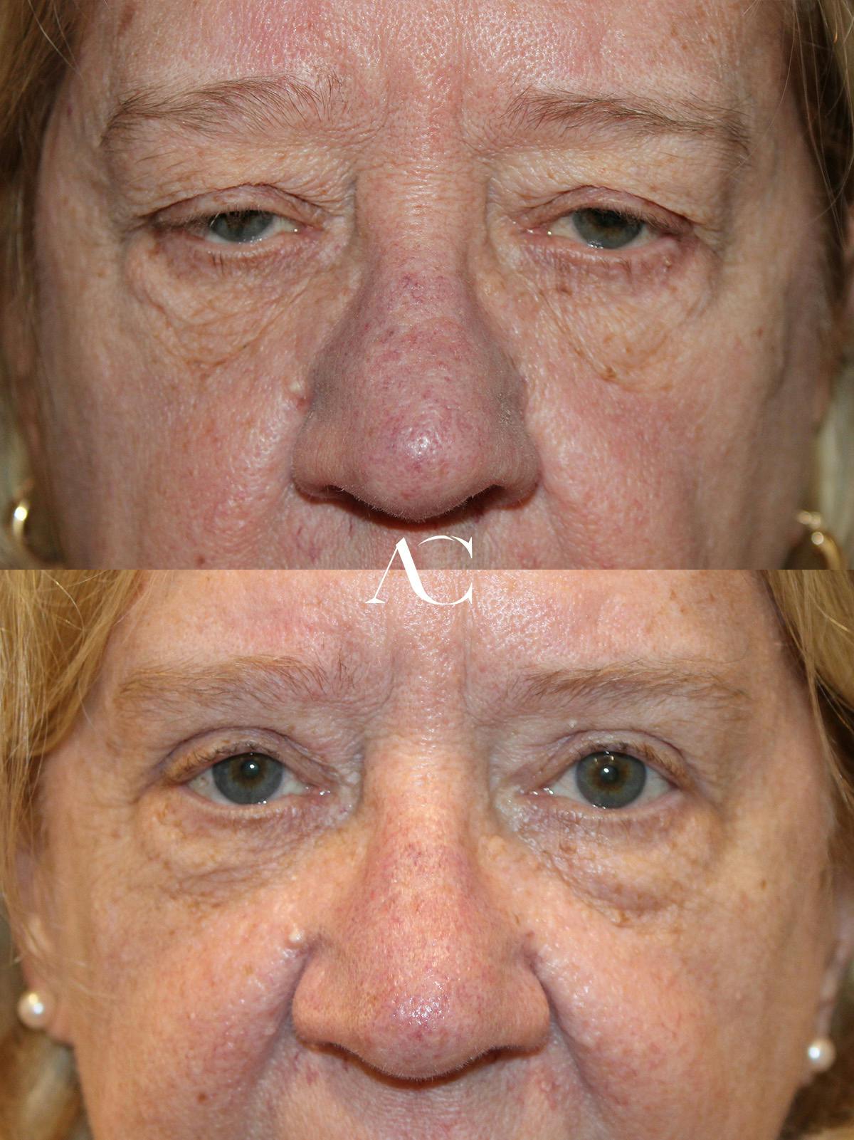 Botox Before & After Gallery - Patient 295651 - Image 1