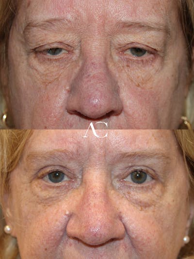 Botox Before & After Gallery - Patient 295651 - Image 1