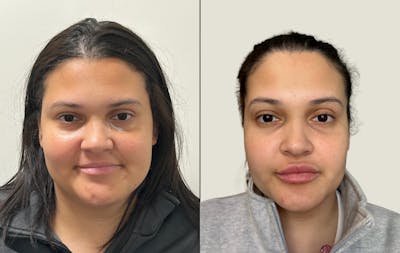 Lip Filler Before & After Gallery - Patient 426419 - Image 1