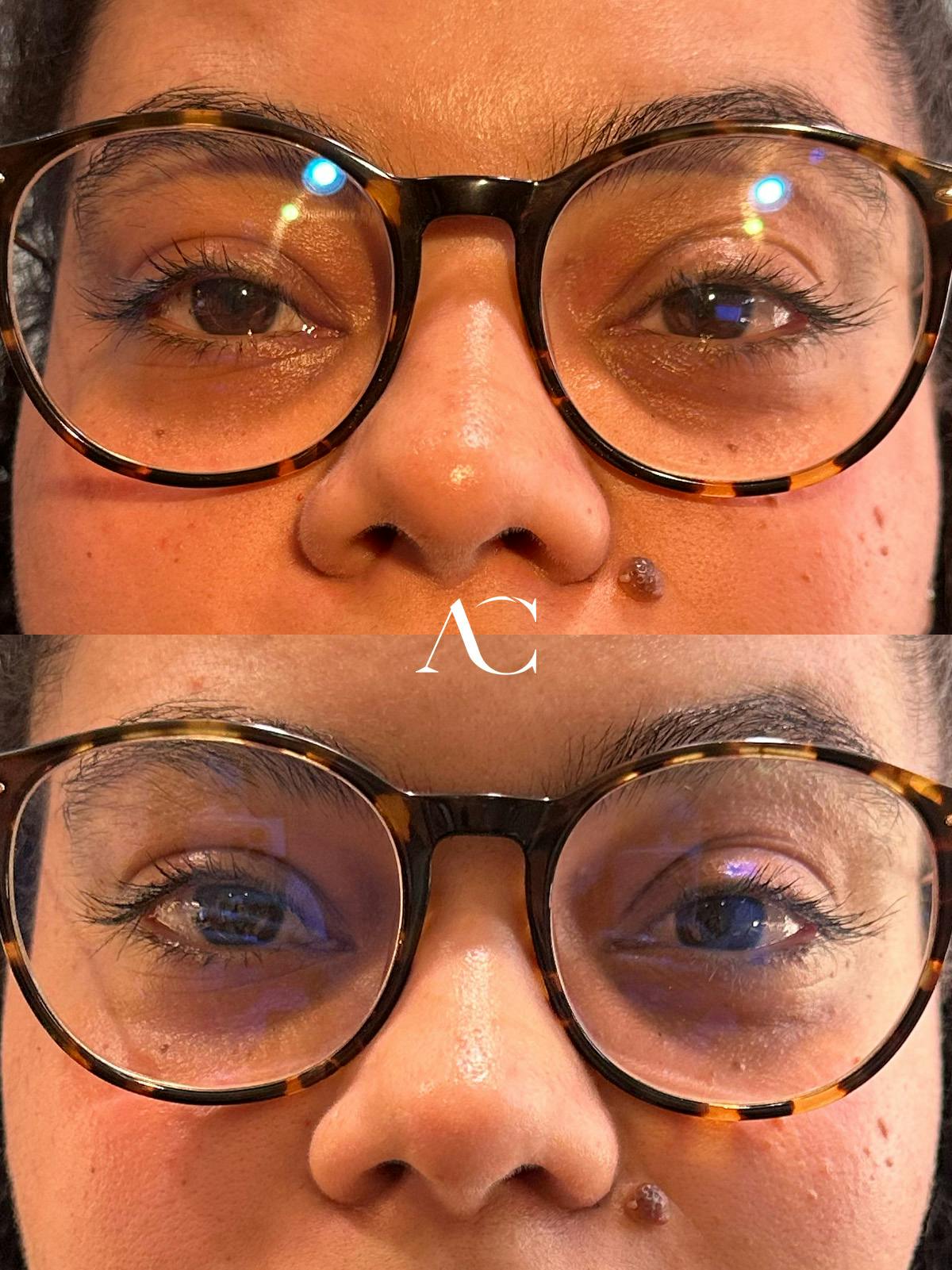 Ptosis Repair Before & After Gallery - Patient 179019 - Image 1