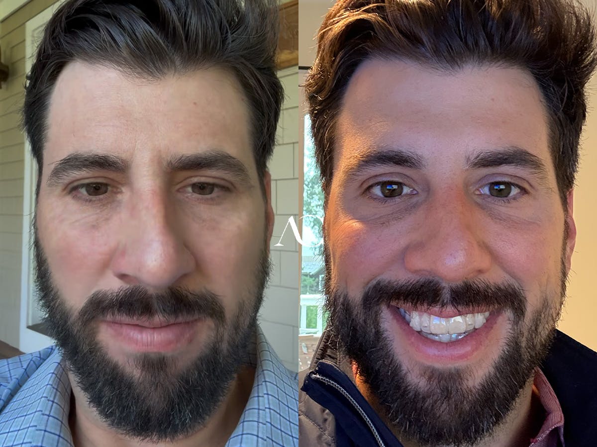 Botox Before & After Gallery - Patient 863132 - Image 1