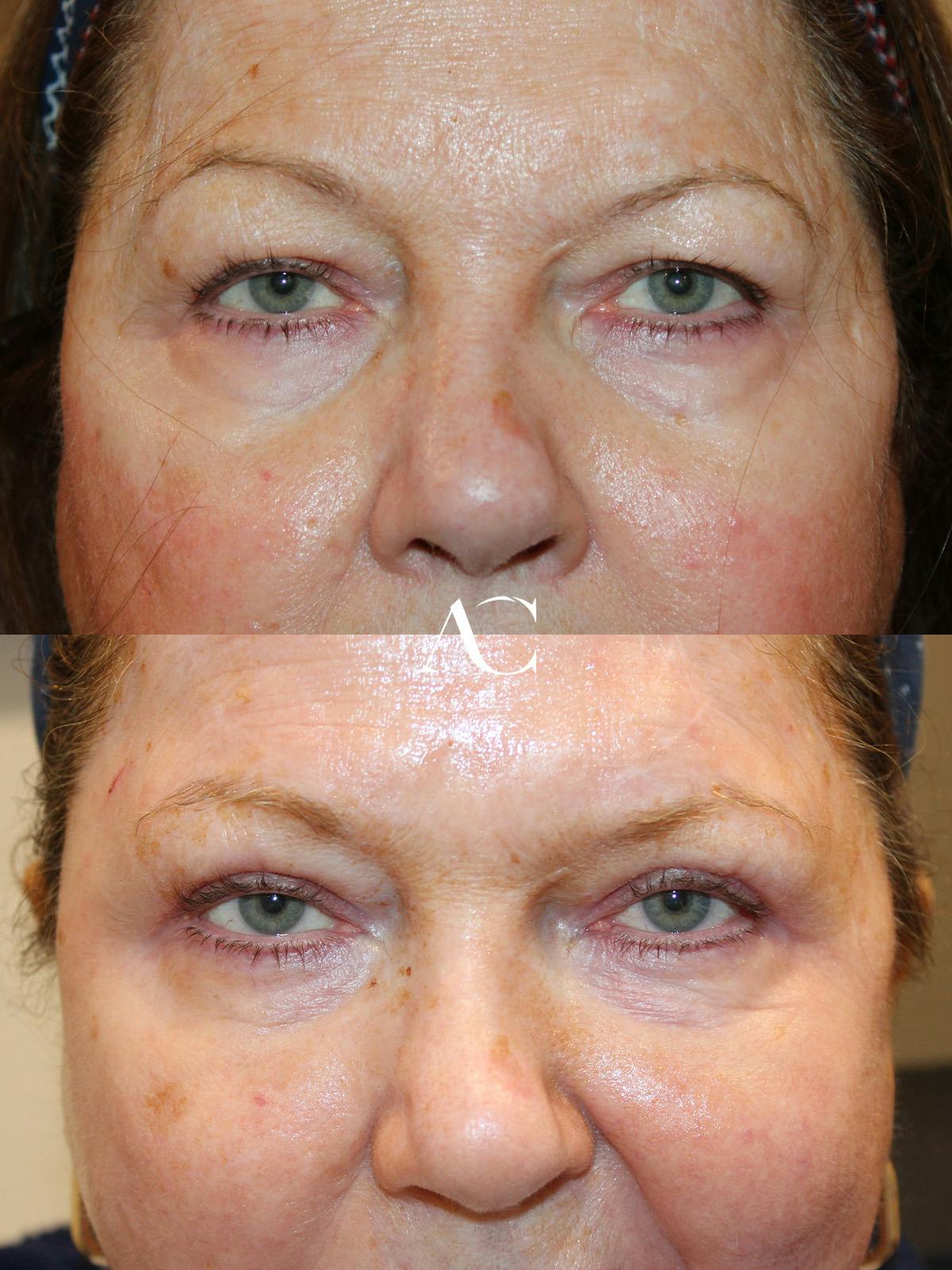 Upper Blepharoplasty Before & After Gallery - Patient 183827 - Image 1