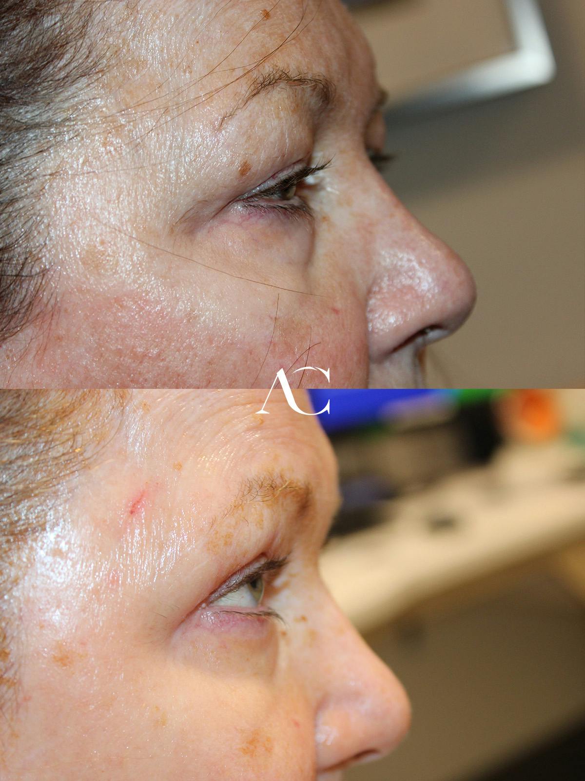 Upper Blepharoplasty Before & After Gallery - Patient 183827 - Image 2