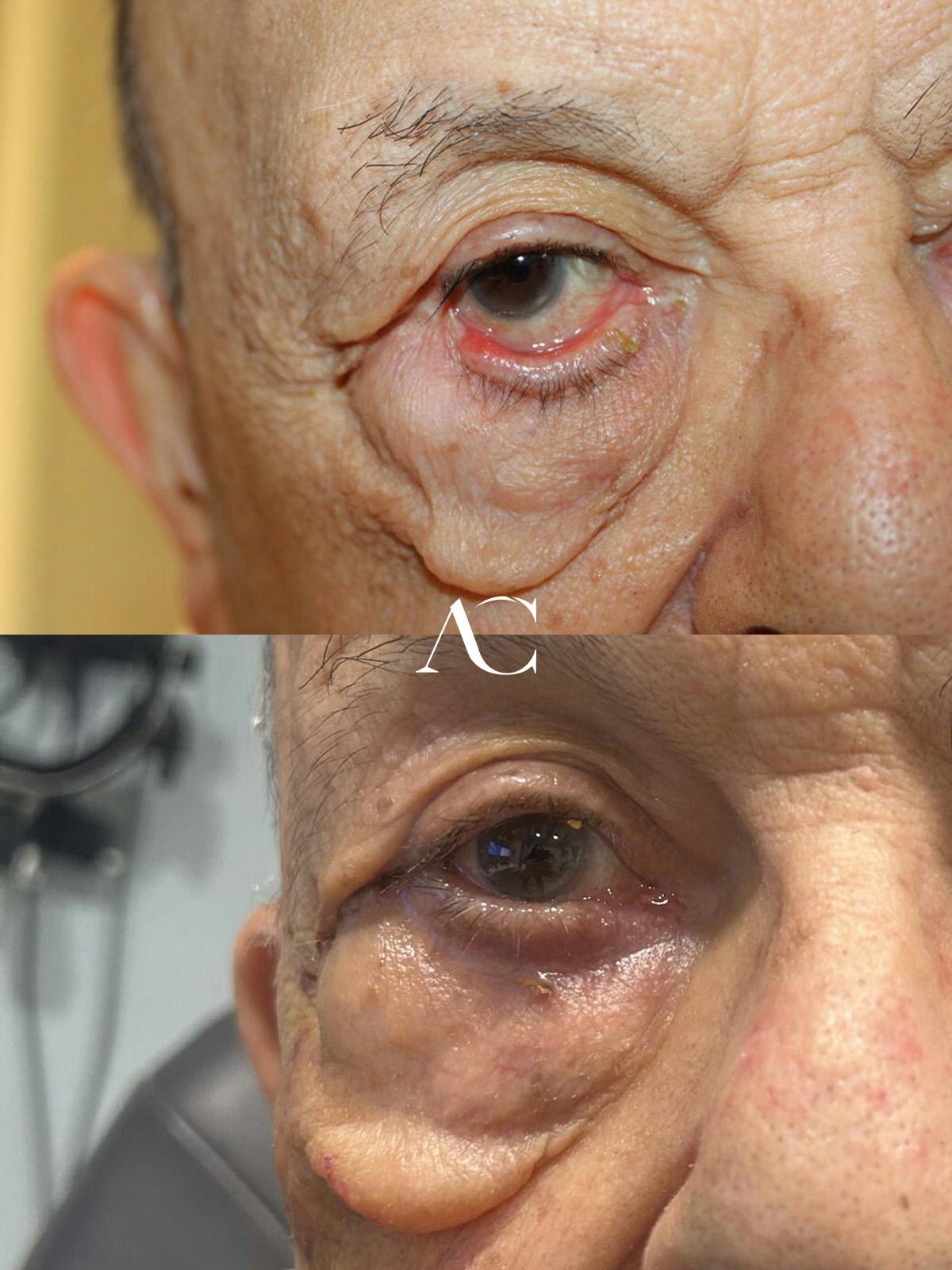 Eyelid Malposition Before & After Gallery - Patient 780971 - Image 1