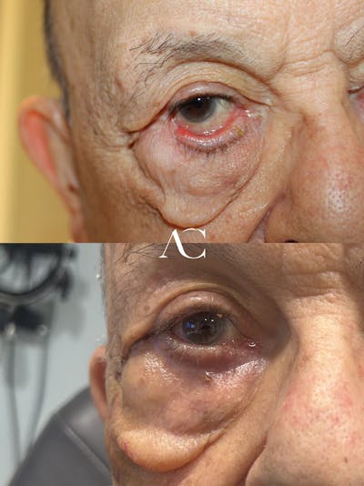 Eyelid Malposition Before & After Gallery - Patient 780971 - Image 1