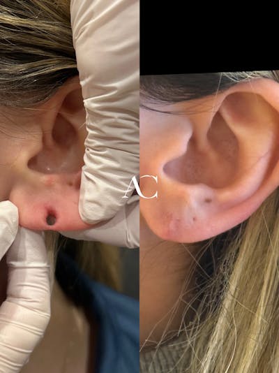 Earlobe Repair Before & After Gallery - Patient 133473 - Image 1