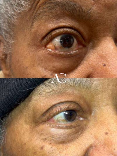 Orbital Tumors Before & After Gallery - Patient 206192 - Image 1