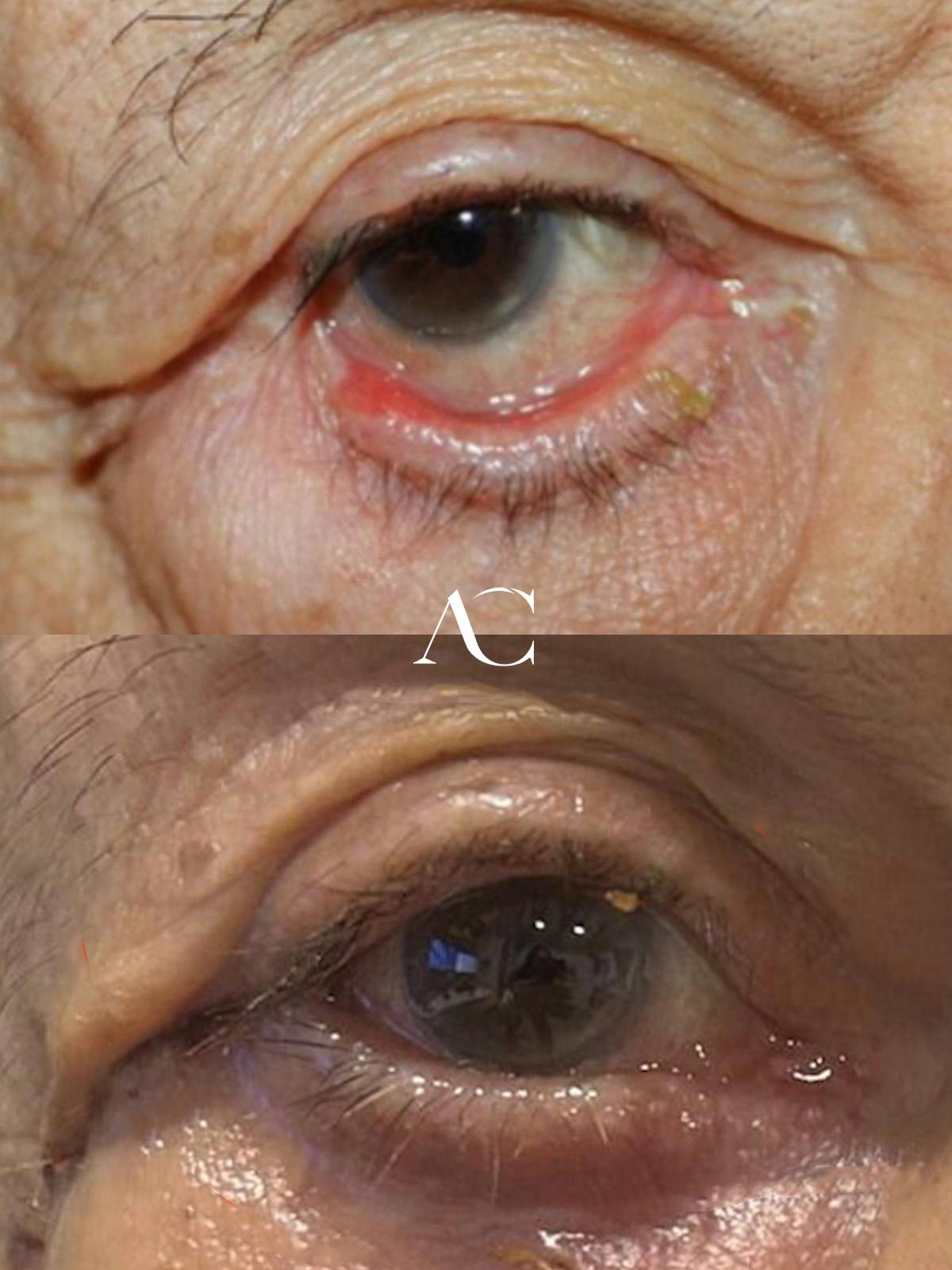 Eyelid Malposition Before & After Gallery - Patient 780971 - Image 1