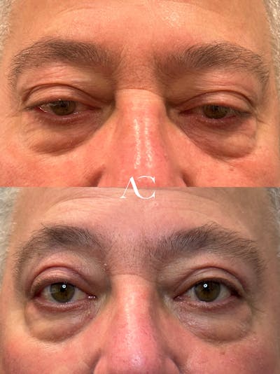 Ptosis Repair Before & After Gallery - Patient 364517 - Image 1