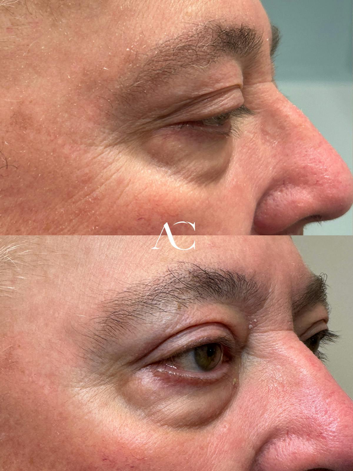Ptosis Repair Before & After Gallery - Patient 364517 - Image 2