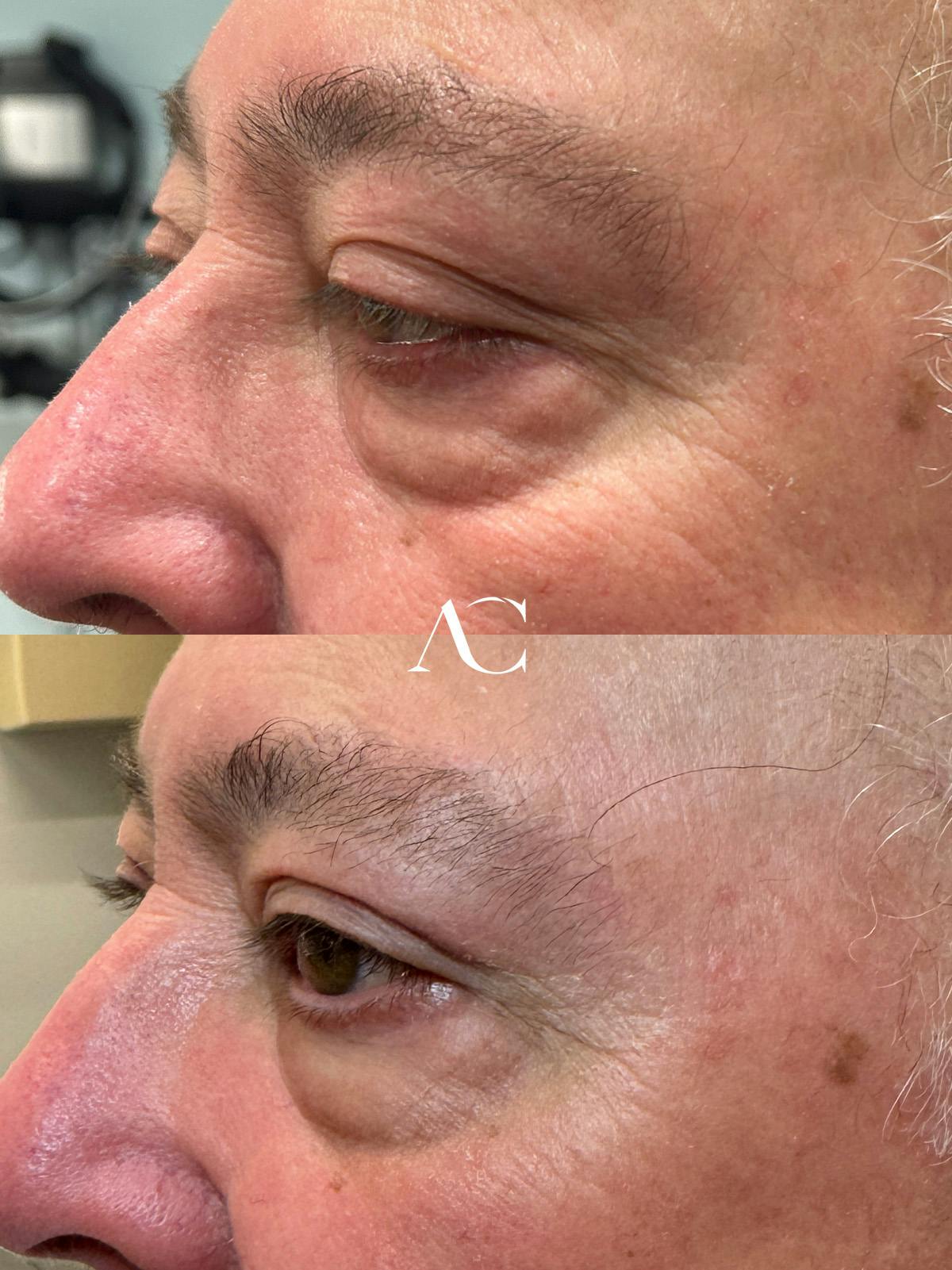 Ptosis Repair Before & After Gallery - Patient 364517 - Image 3
