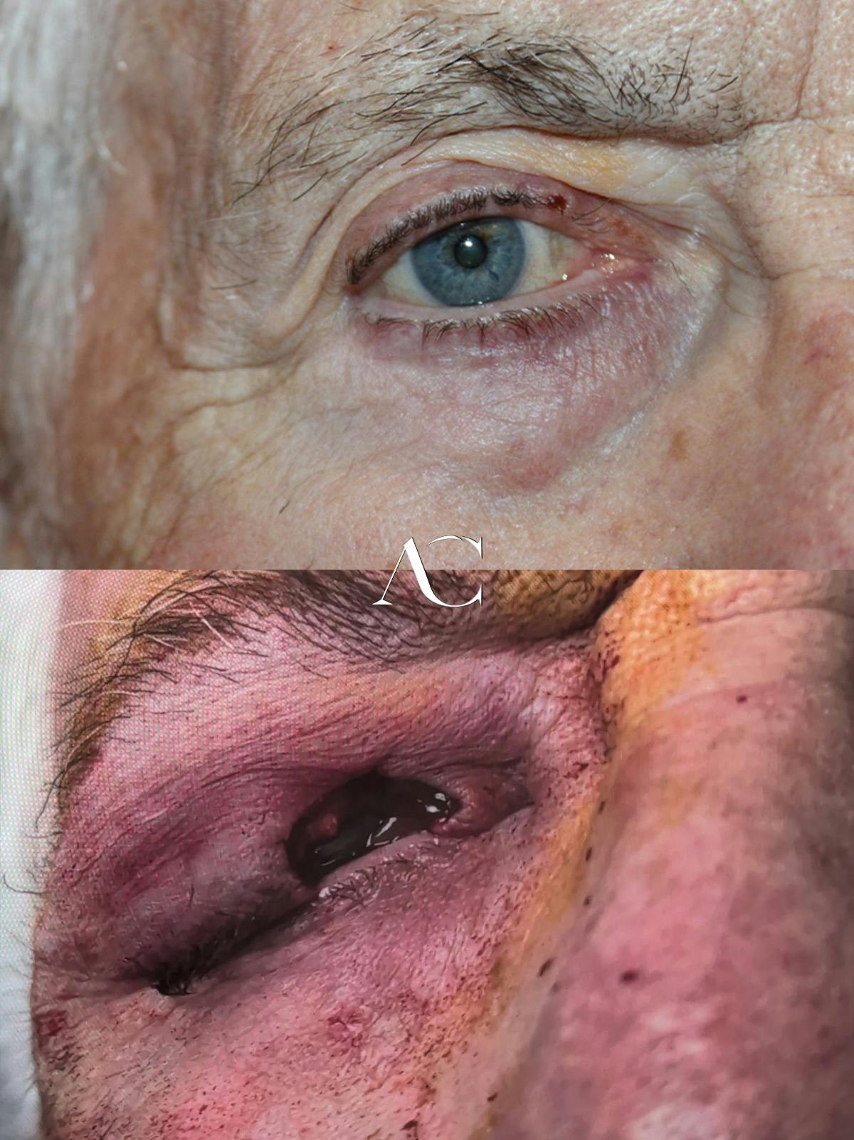 Mohs Reconstruction Before & After Gallery - Patient 293353 - Image 1