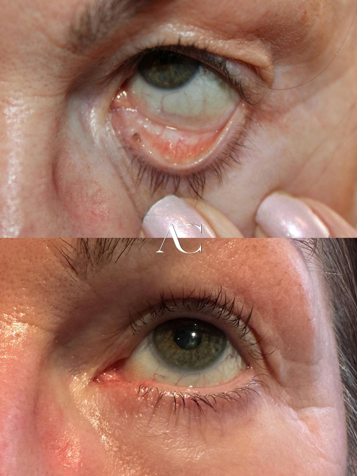 Mohs Reconstruction Before & After Gallery - Patient 312457 - Image 1