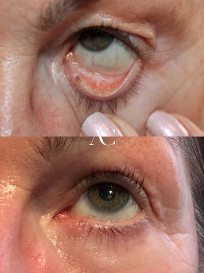 Mohs Reconstruction Before & After Gallery - Patient 312457 - Image 1