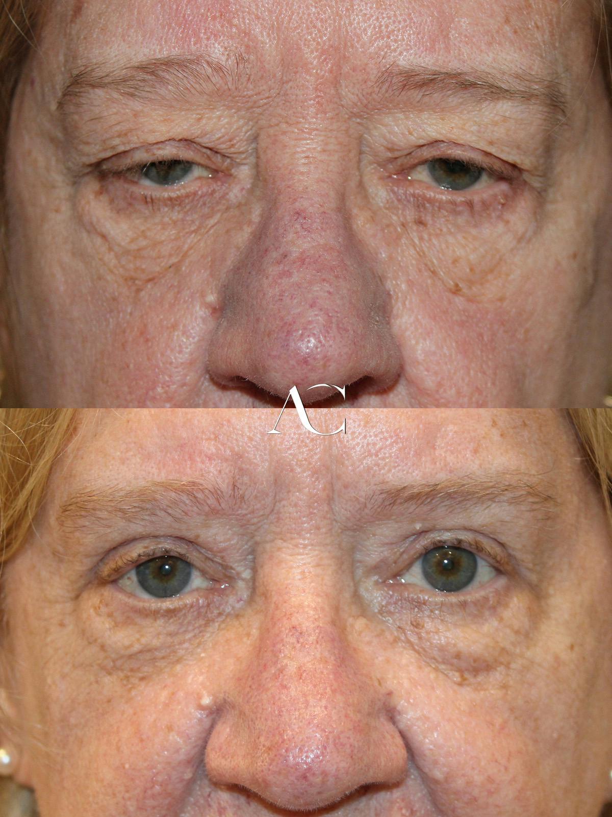 Ptosis Repair Before & After Gallery - Patient 964862 - Image 1