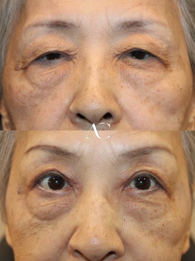 Upper Blepharoplasty Before & After Gallery - Patient 309030 - Image 1